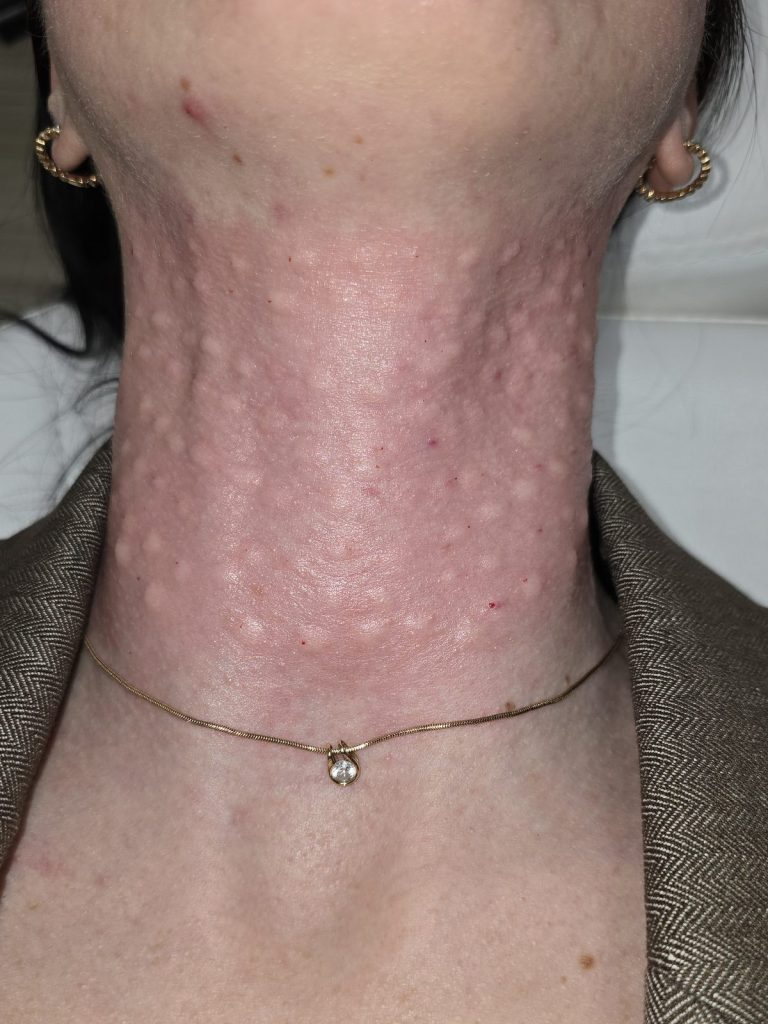 Neck biorevitalization treatment area right after injection
