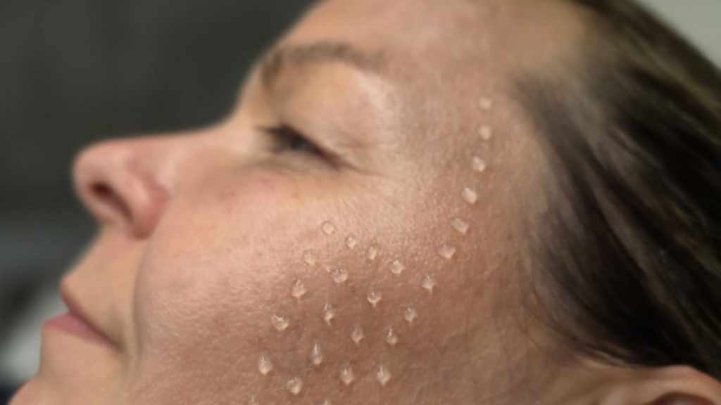 Biorevitalization micro-injections on the cheek in Maple, Vaughan