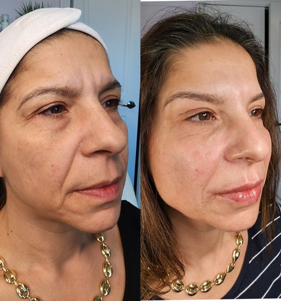 Before and after cheek filler at Beauty Maison Aesthetics in Maple, Vaughan (individual results vary)