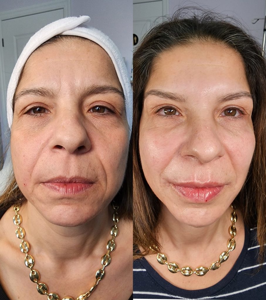 Before and after cheek filler at Beauty Maison Aesthetics in Maple, Vaughan (individual results vary)