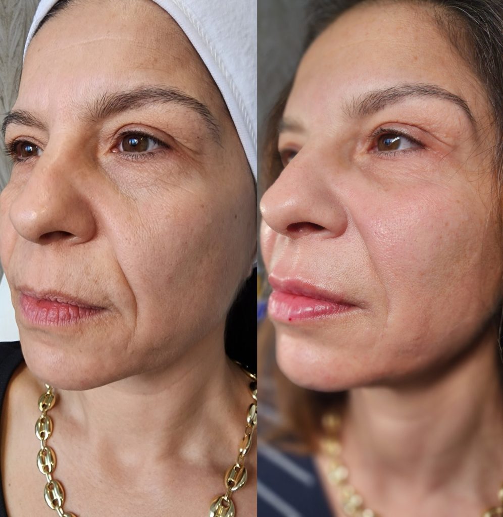 Before and after cheek filler at Beauty Maison Aesthetics in Maple, Vaughan (individual results vary)