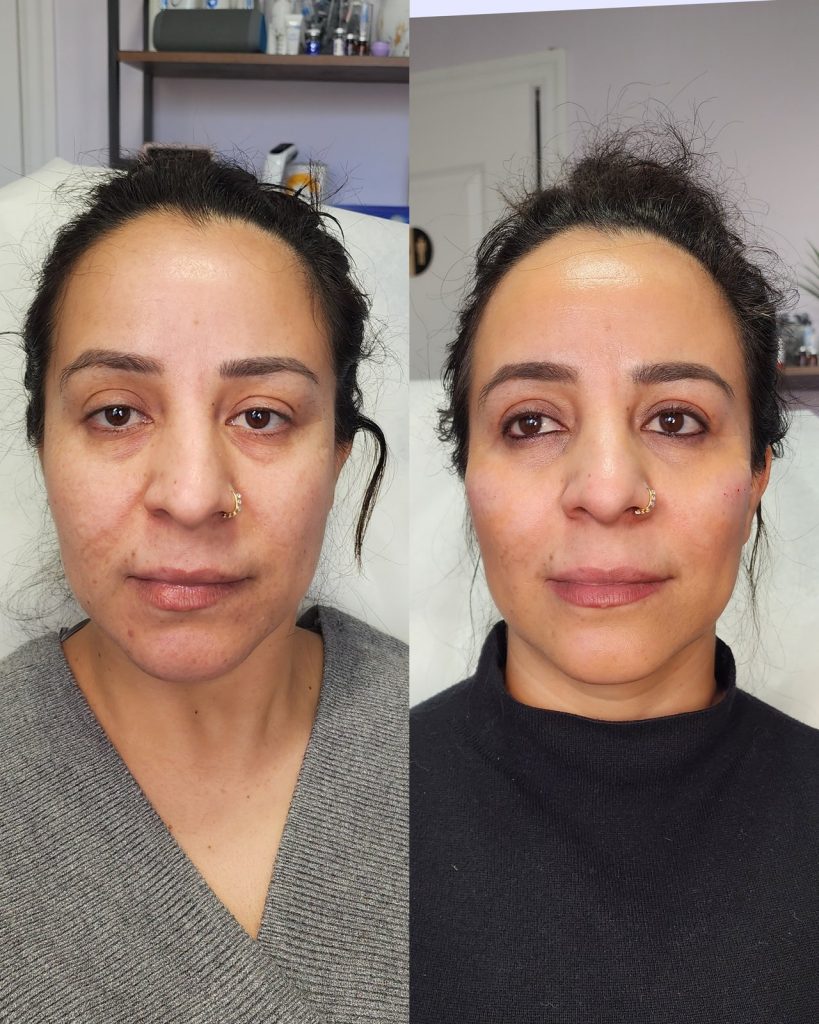 Before and after cheek filler at Beauty Maison Aesthetics in Maple, Vaughan (individual results vary)
