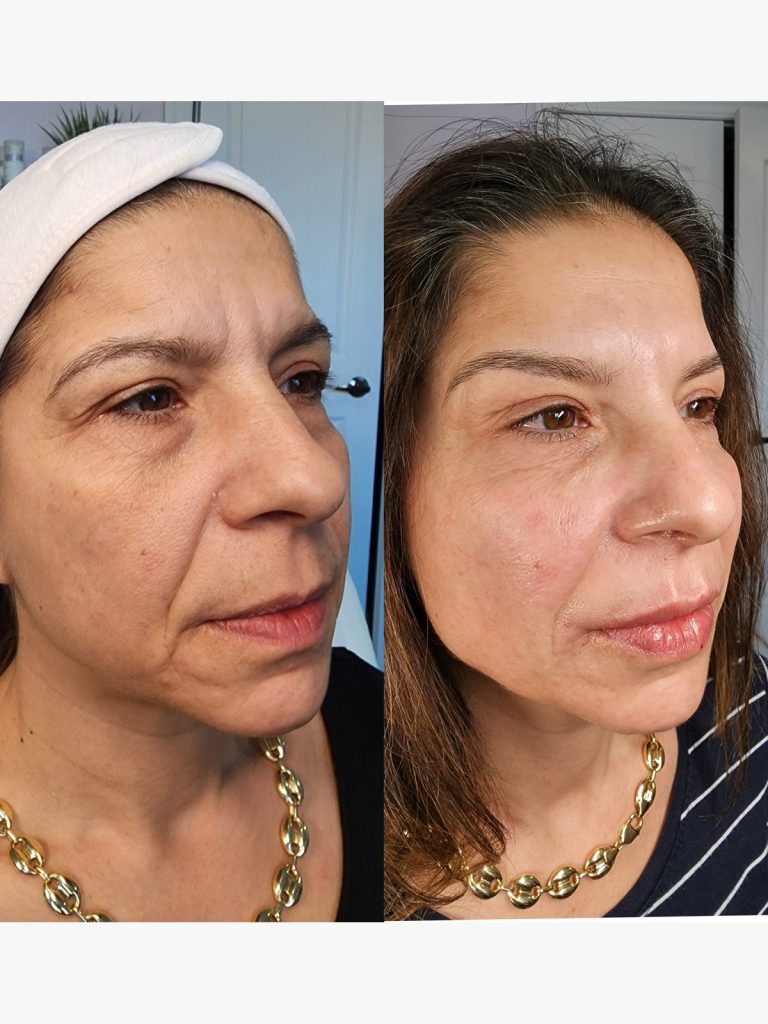 Before and after cheek filler restoring mid-face volume at Beauty Maison Aesthetics in Maple, Vaughan (individual results vary)