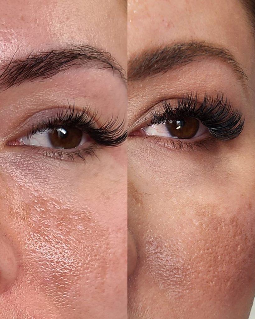 Before and after chemical peel at Beauty Maison Aesthetics in Maple, Vaughan (individual results vary)