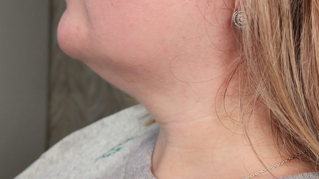Profile of the chin and jawline, the most common area for fat-dissolving injections, at a Vaughan clinic