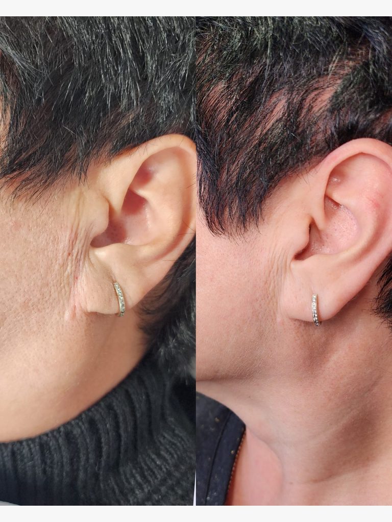 Before and after earlobe filler supporting a stretched piercing at Beauty Maison Aesthetics in Maple, Vaughan (individual results vary)