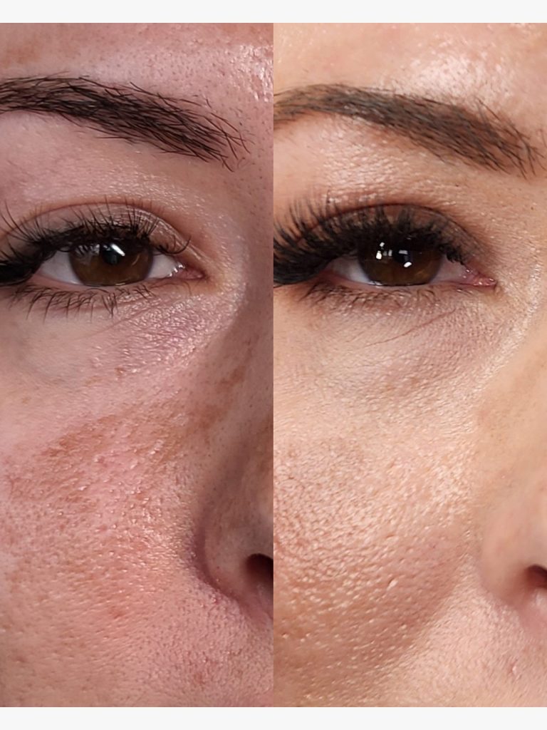 Before and after an under-eye lightening peel at Beauty Maison Aesthetics in Maple, Vaughan (individual results vary)