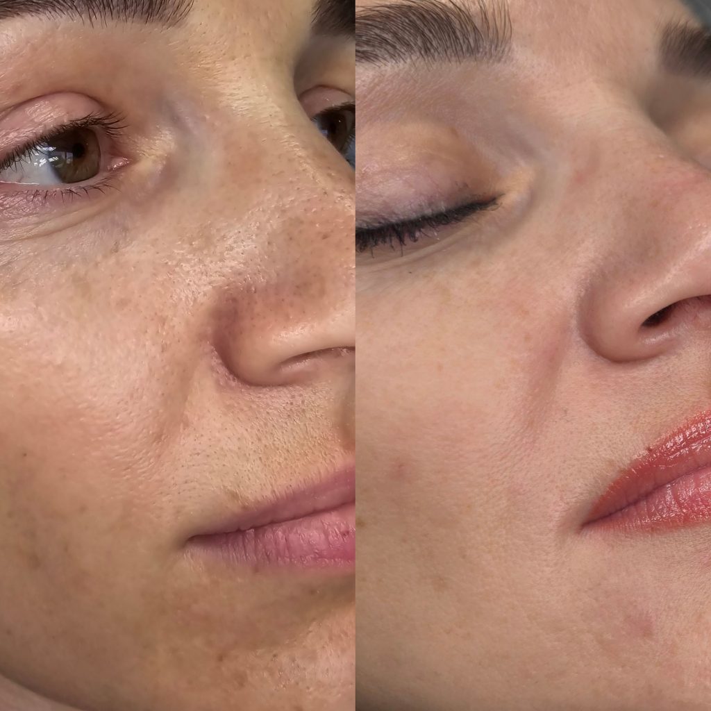 Before and after glass facial at Beauty Maison Aesthetics in Maple, Vaughan (individual results vary)