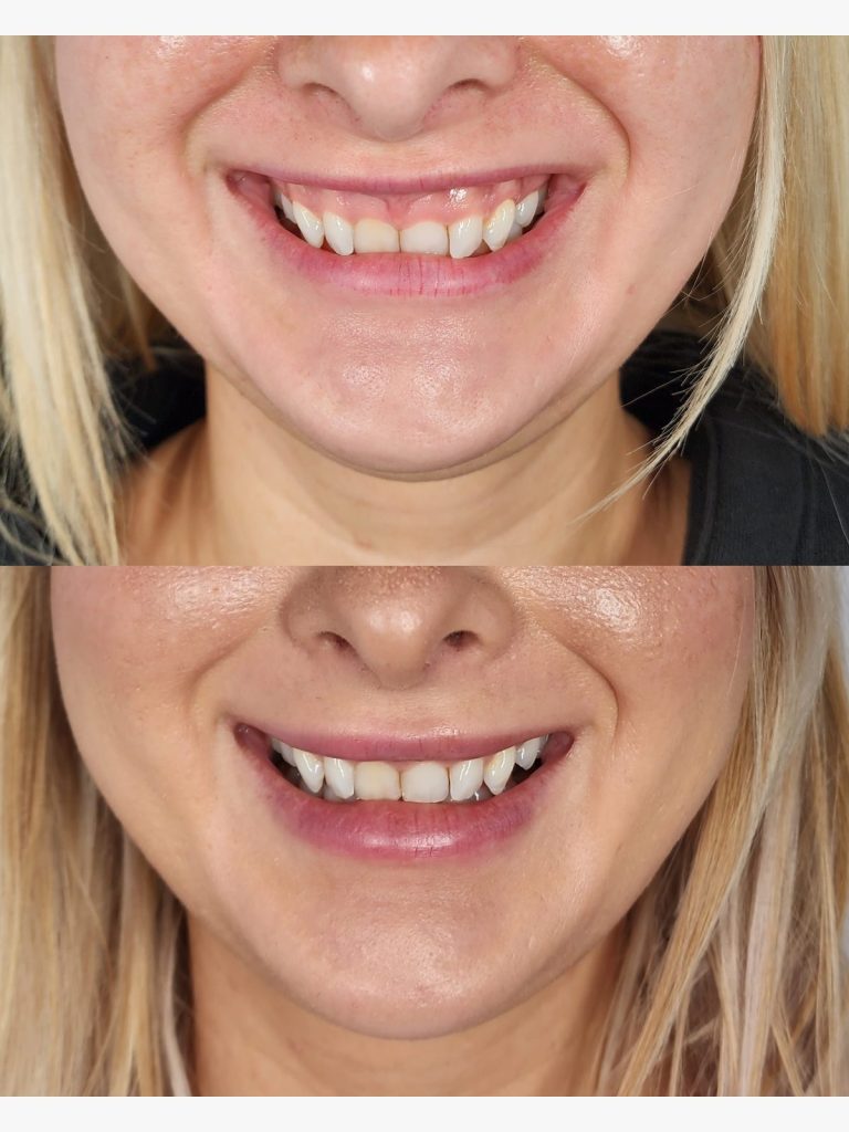 Before and after gummy smile treatment at Beauty Maison Aesthetics in Maple, Vaughan (individual results vary)