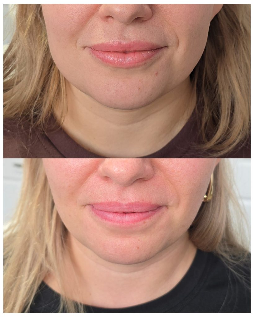 Before and after jaw slimming / bruxism at Beauty Maison Aesthetics in Maple, Vaughan (individual results vary)