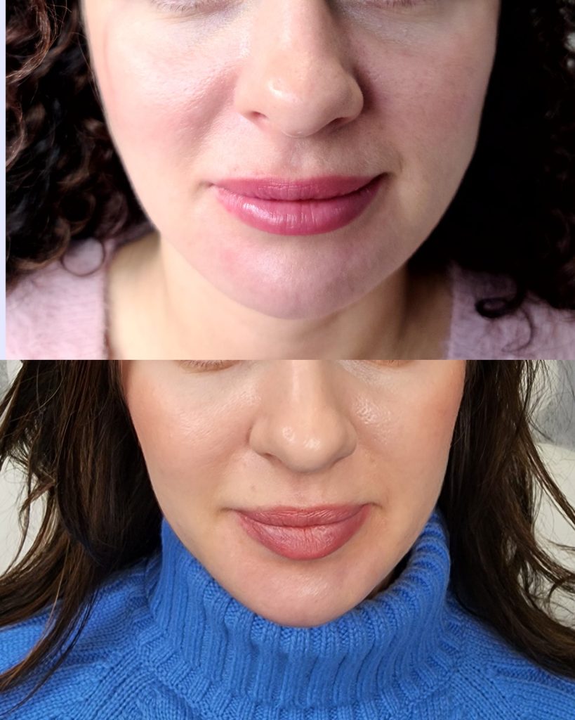 Before and after jaw slimming / bruxism at Beauty Maison Aesthetics in Maple, Vaughan (individual results vary)