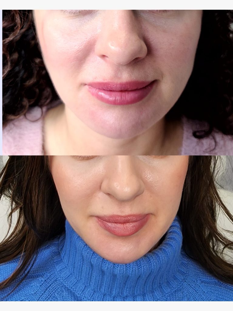 Before and after jaw slimming (masseter) treatment for clenching at Beauty Maison Aesthetics in Maple, Vaughan (individual results vary)