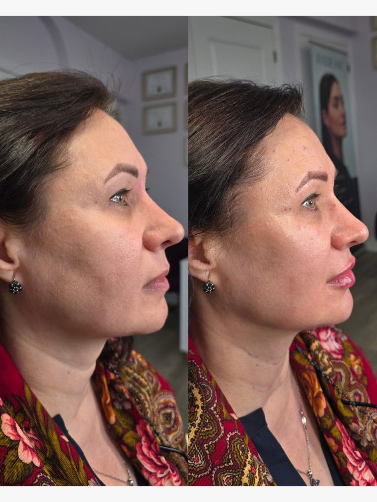 Before and after jawline and pre-jowl filler, profile view at Beauty Maison Aesthetics in Maple, Vaughan (individual results vary)