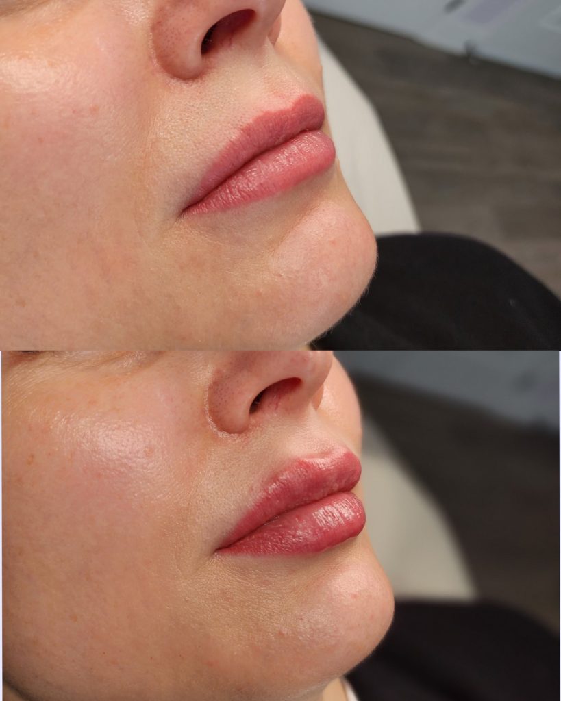 Before and after lip filler at Beauty Maison Aesthetics in Maple, Vaughan (individual results vary)