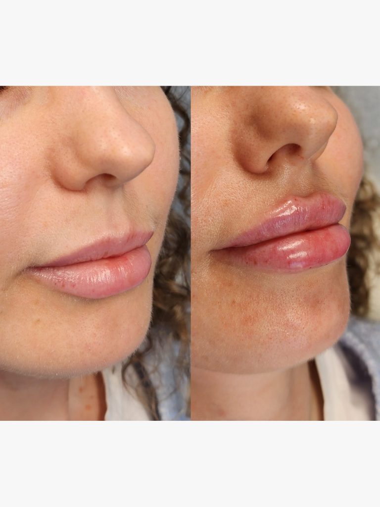 Before and after lip filler, side view at Beauty Maison Aesthetics in Maple, Vaughan (individual results vary)