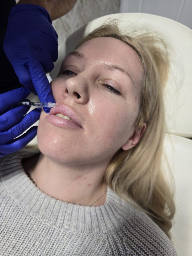 Treatment around the upper lip at Beauty Maison Aesthetics, Vaughan