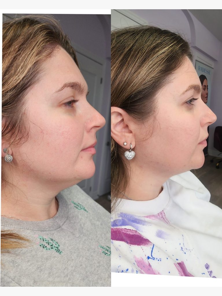 Before and after fat-dissolving injections under the chin, profile view at Beauty Maison Aesthetics in Maple, Vaughan (individual results vary)
