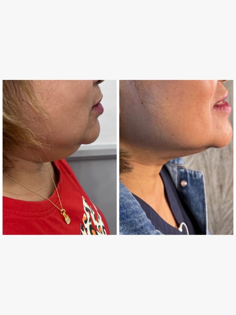 Before and after fat-dissolving injections along the jawline and under the chin at Beauty Maison Aesthetics in Maple, Vaughan (individual results vary)