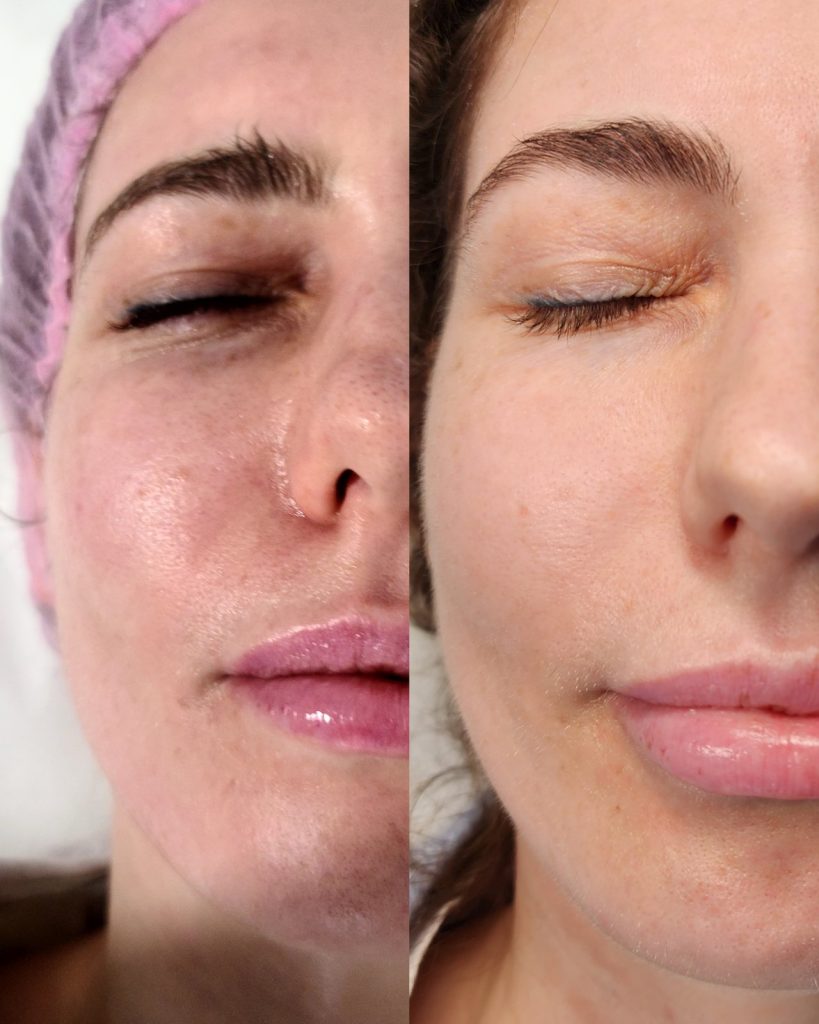 Before and after microneedling at Beauty Maison Aesthetics in Maple, Vaughan (individual results vary)