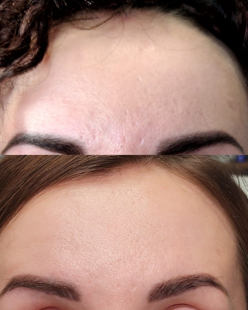 Before and after microneedling at Beauty Maison Aesthetics in Maple, Vaughan (individual results vary)