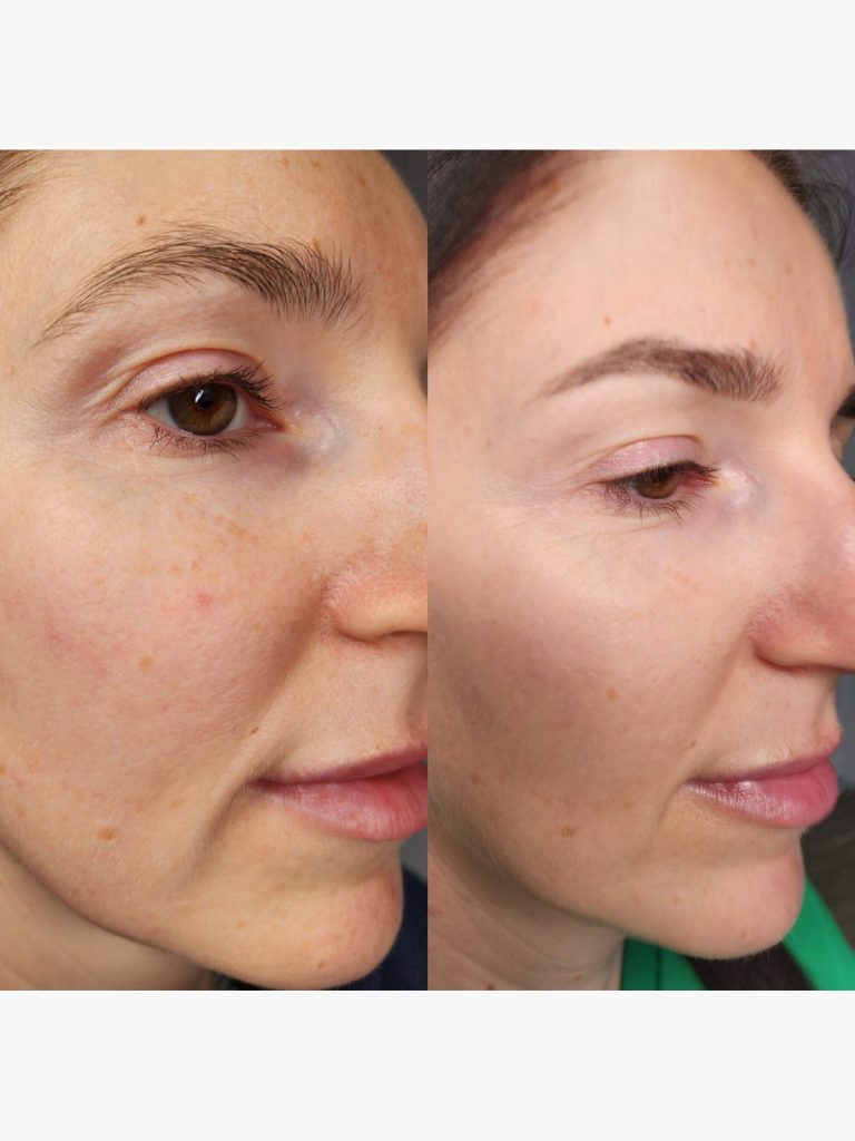Before and after microneedling around the eye and cheek at Beauty Maison Aesthetics in Maple, Vaughan (individual results vary)