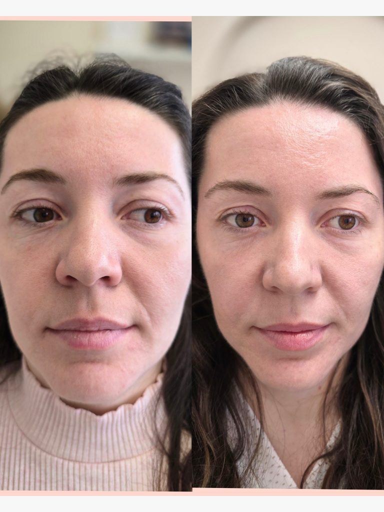 Before and after microneedling with mesotherapy at Beauty Maison Aesthetics in Maple, Vaughan (individual results vary)
