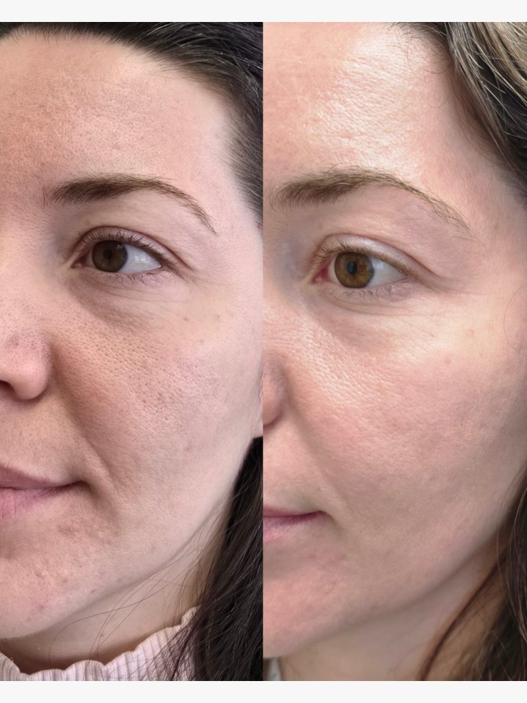 Before and after microneedling with PDRN at Beauty Maison Aesthetics in Maple, Vaughan (individual results vary)