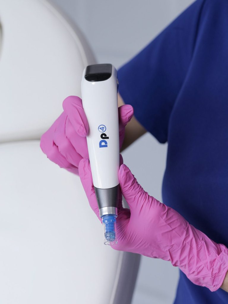 Microneedling pen prepared for a PRP microneedling treatment