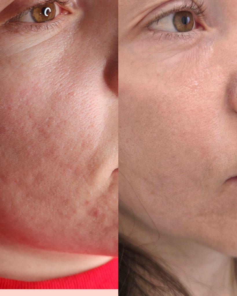Before and after microneedling with pdrn at Beauty Maison Aesthetics in Maple, Vaughan (individual results vary)