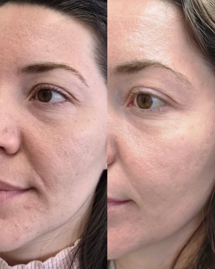 Before and after microneedling with pdrn at Beauty Maison Aesthetics in Maple, Vaughan (individual results vary)