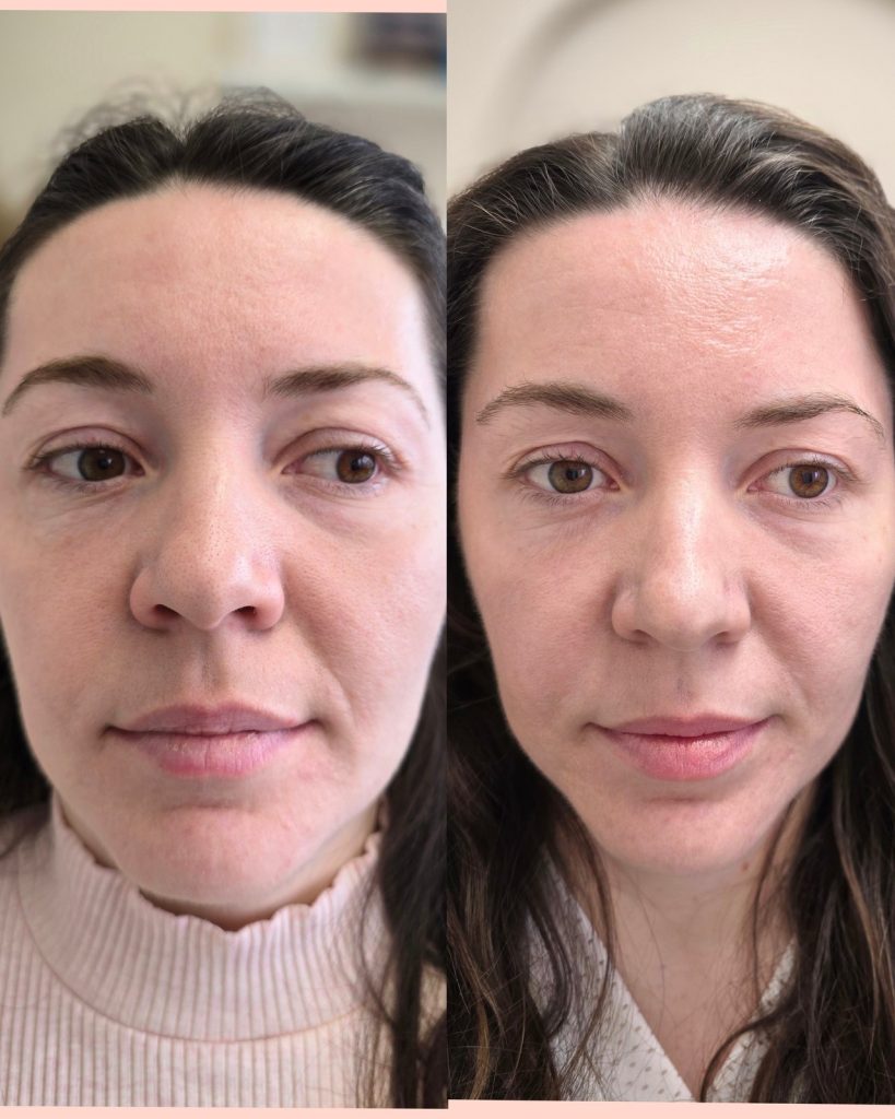 Before and after microneedling with pdrn at Beauty Maison Aesthetics in Maple, Vaughan (individual results vary)