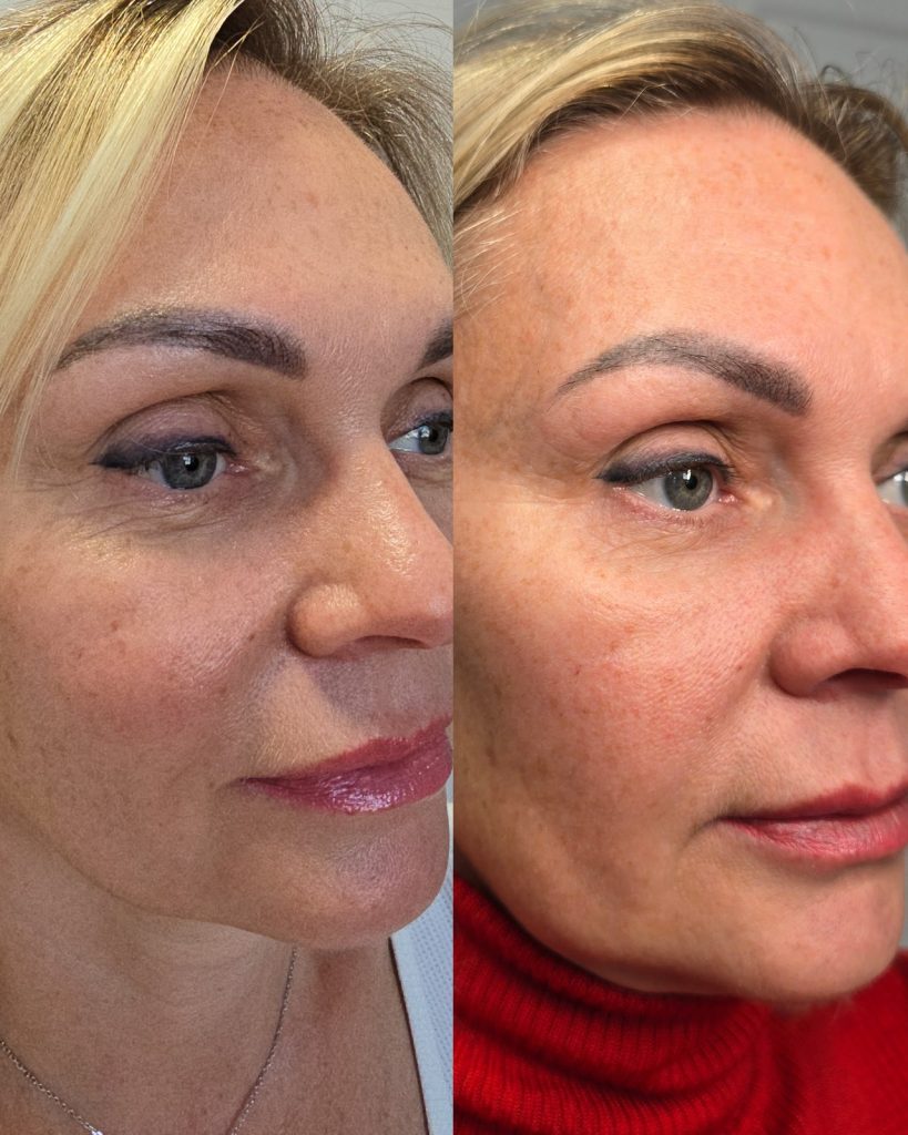 Before and after NCTF skin booster at Beauty Maison Aesthetics in Maple, Vaughan (individual results vary)