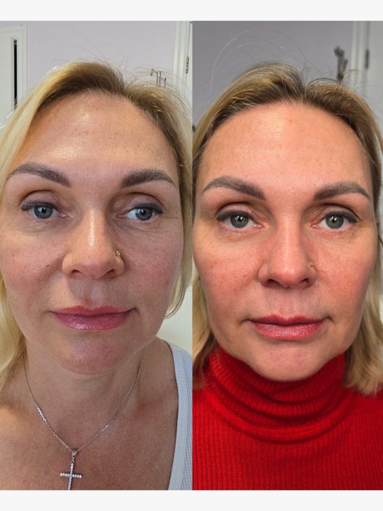 Before and after NCTF skin booster at Beauty Maison Aesthetics in Maple, Vaughan (individual results vary)