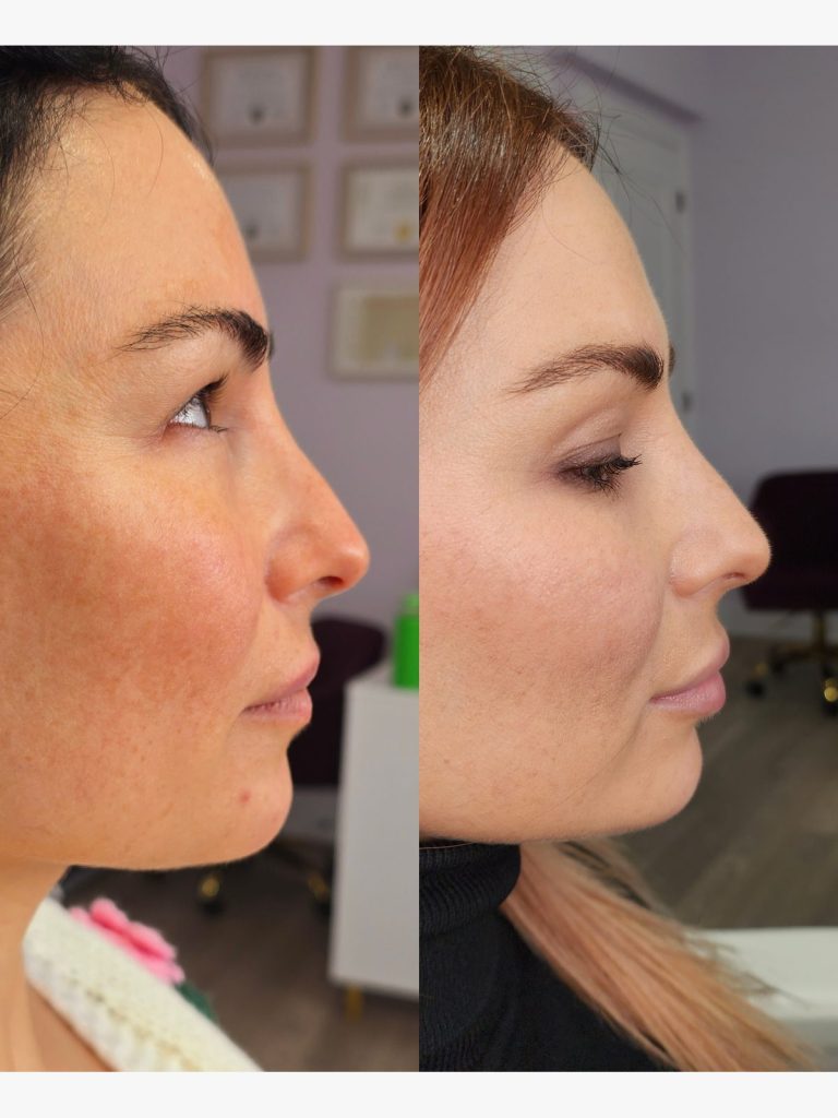 Before and after a nose lift treatment, profile view at Beauty Maison Aesthetics in Maple, Vaughan (individual results vary)