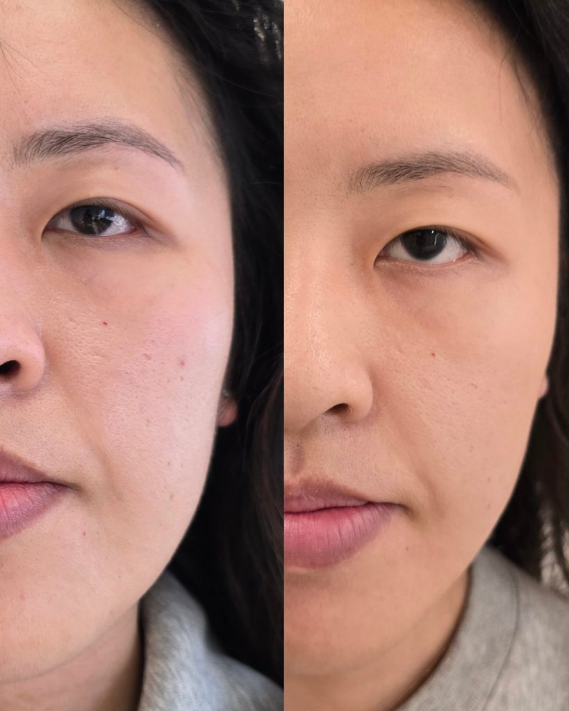 Before and after PDRN, full face at Beauty Maison Aesthetics in Maple, Vaughan (individual results vary)