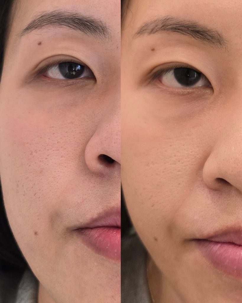 Before and after PDRN, full face at Beauty Maison Aesthetics in Maple, Vaughan (individual results vary)