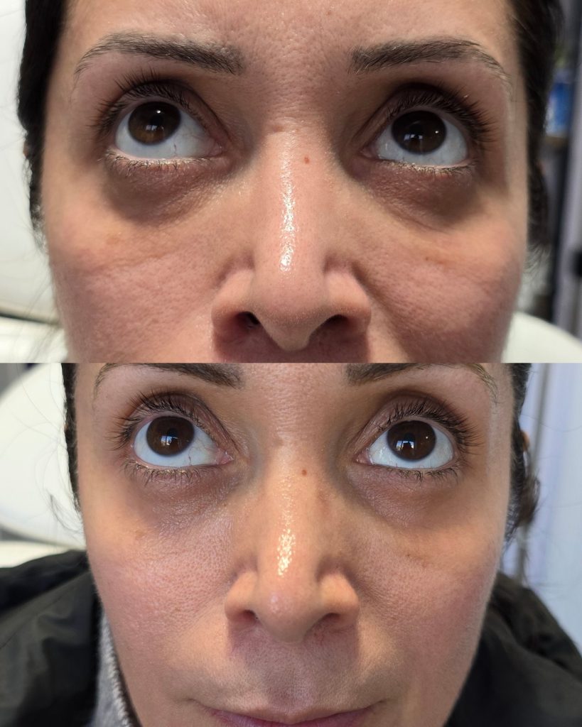 Before and after PDRN, under-eye at Beauty Maison Aesthetics in Maple, Vaughan (individual results vary)