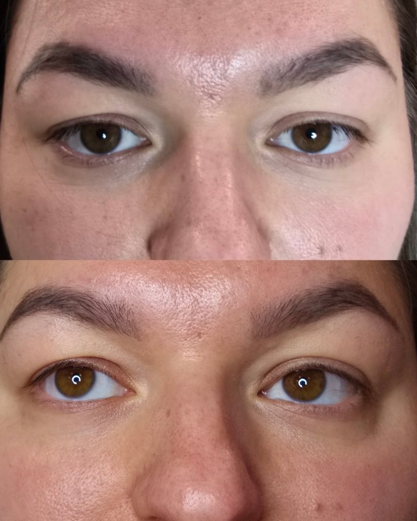 Before and after PDRN, under-eye at Beauty Maison Aesthetics in Maple, Vaughan (individual results vary)