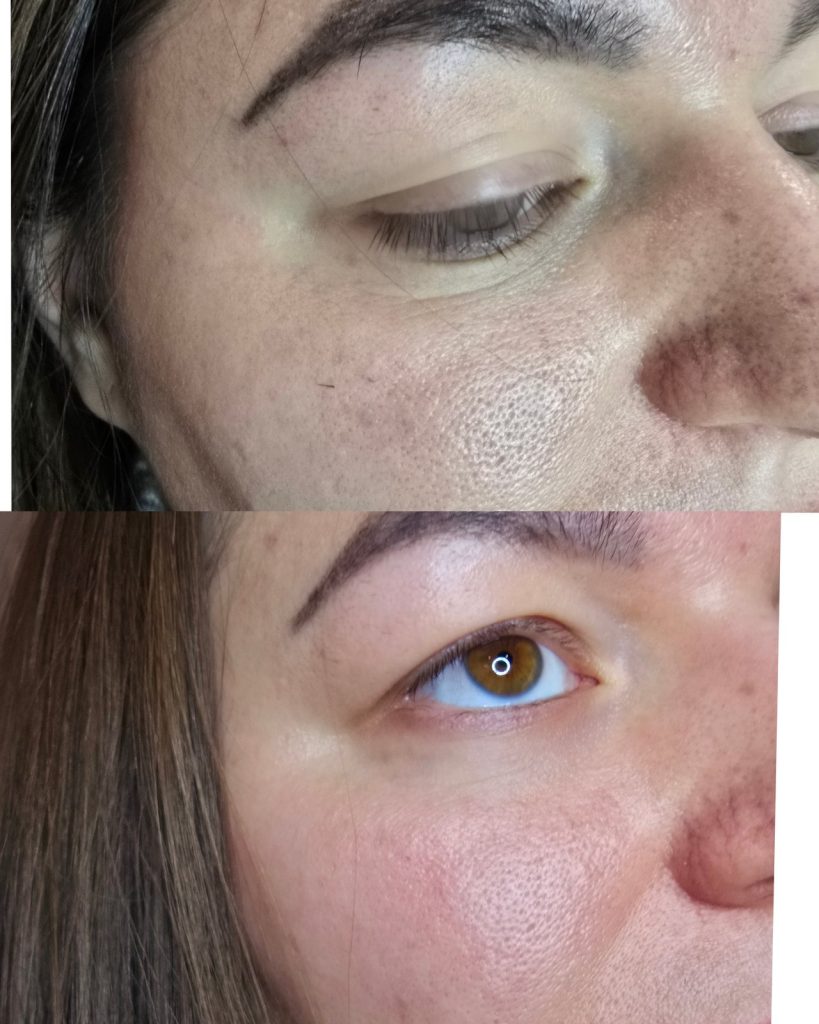 Before and after PDRN, under-eye at Beauty Maison Aesthetics in Maple, Vaughan (individual results vary)