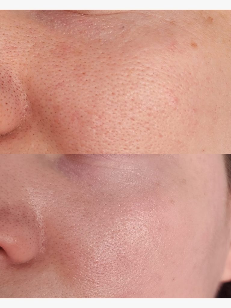 Before and after treatment for skin texture at Beauty Maison Aesthetics in Maple, Vaughan (individual results vary)