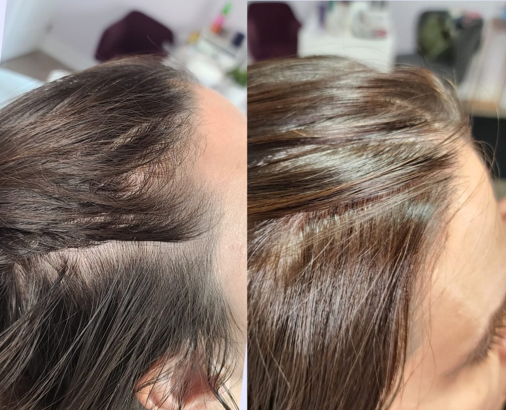 Before and after PRP for hair at Beauty Maison Aesthetics in Maple, Vaughan (individual results vary)