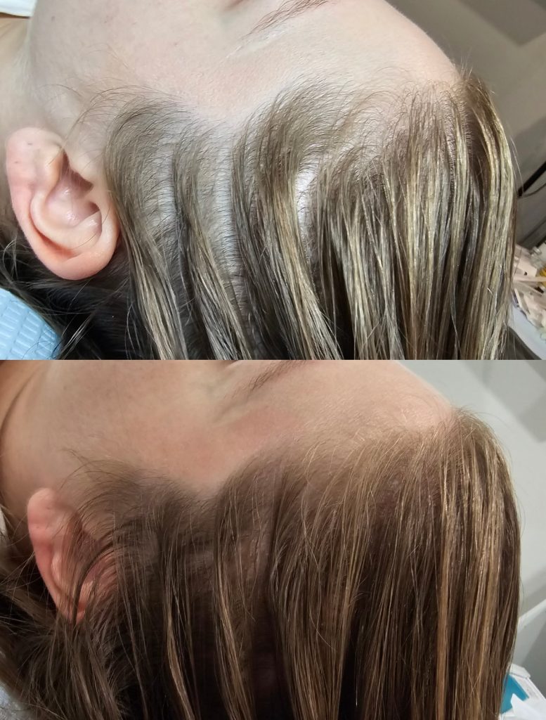 Before and after PRP for hair at Beauty Maison Aesthetics in Maple, Vaughan (individual results vary)