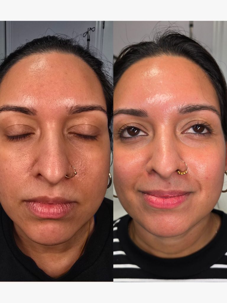 Before and after a microneedling course at Beauty Maison Aesthetics in Maple, Vaughan (individual results vary)