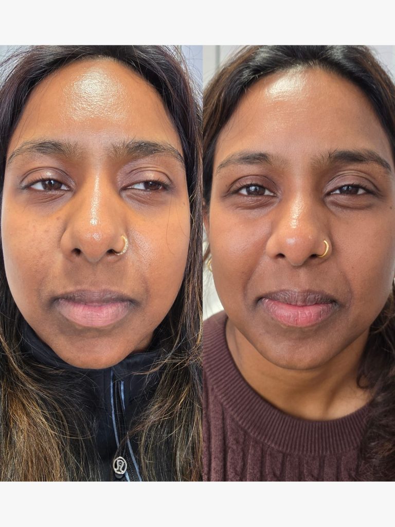 Before and after a PRX-T33 peel, brighter and more even skin at Beauty Maison Aesthetics in Maple, Vaughan (individual results vary)