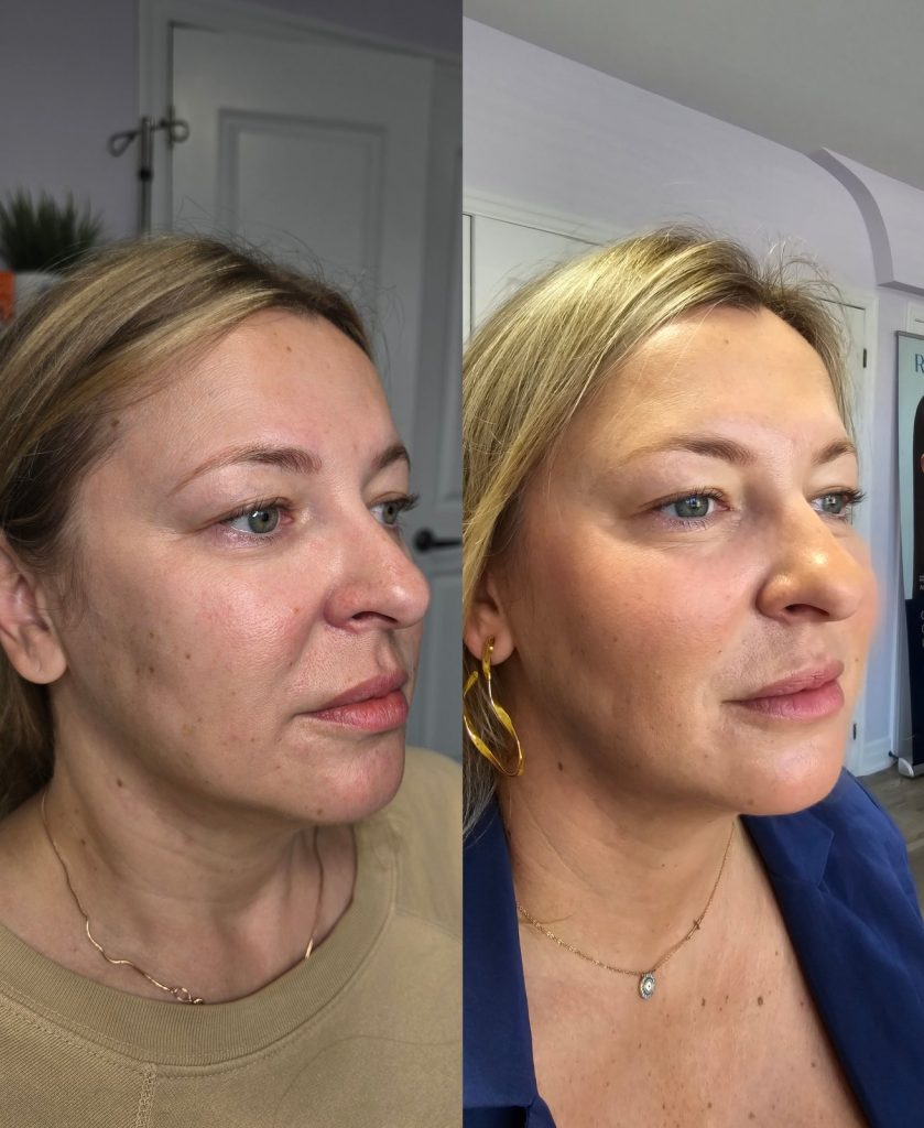 Before and after Radiesse, face at Beauty Maison Aesthetics in Maple, Vaughan (individual results vary)