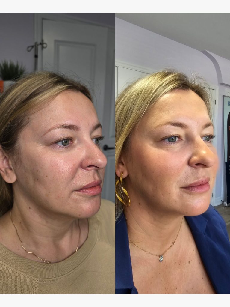 Before and after Radiesse for facial contour at Beauty Maison Aesthetics in Maple, Vaughan (individual results vary)