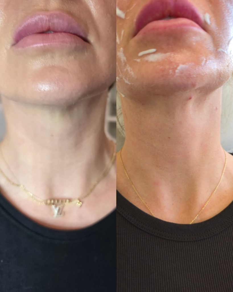 Before and after Radiesse, neck at Beauty Maison Aesthetics in Maple, Vaughan (individual results vary)