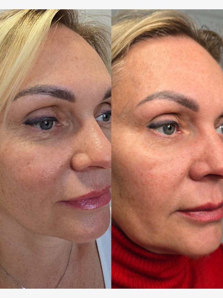 Before and after a skin booster course at Beauty Maison Aesthetics in Maple, Vaughan (individual results vary)