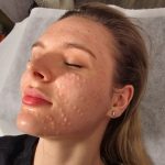 Skin immediately after skin booster micro-injections