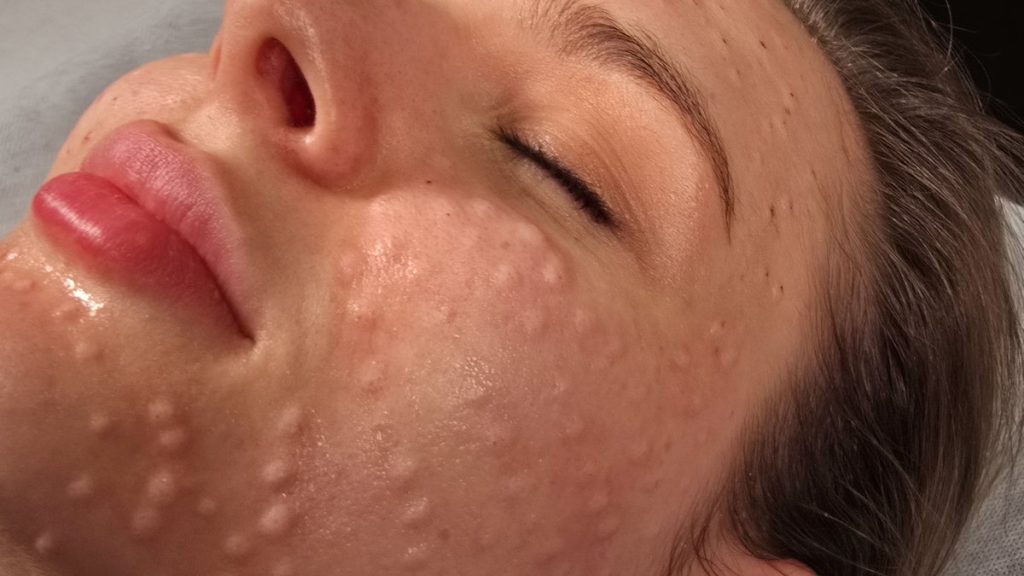Skin booster micro-injection points on the cheek after treatment at Beauty Maison Aesthetics in Maple, Vaughan